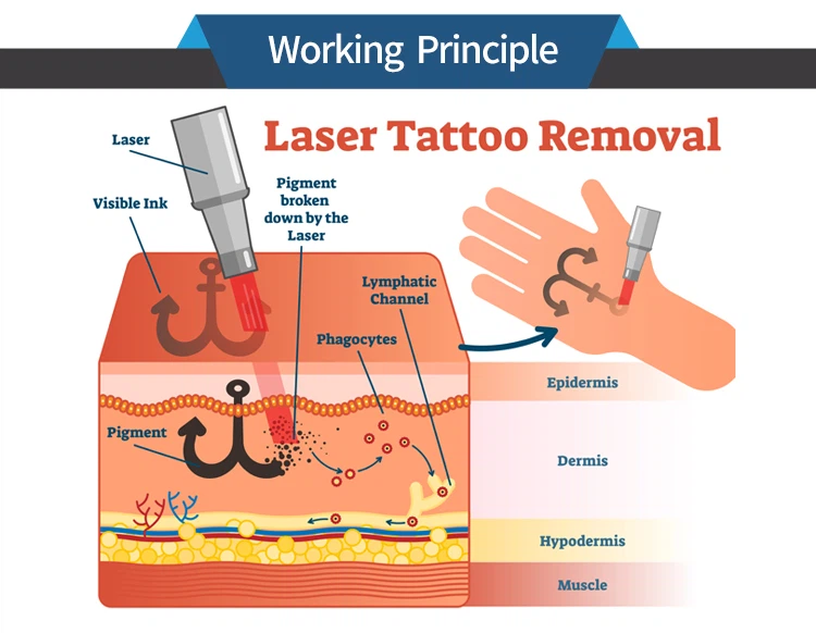 tattoo removal machine tattoo removal machine