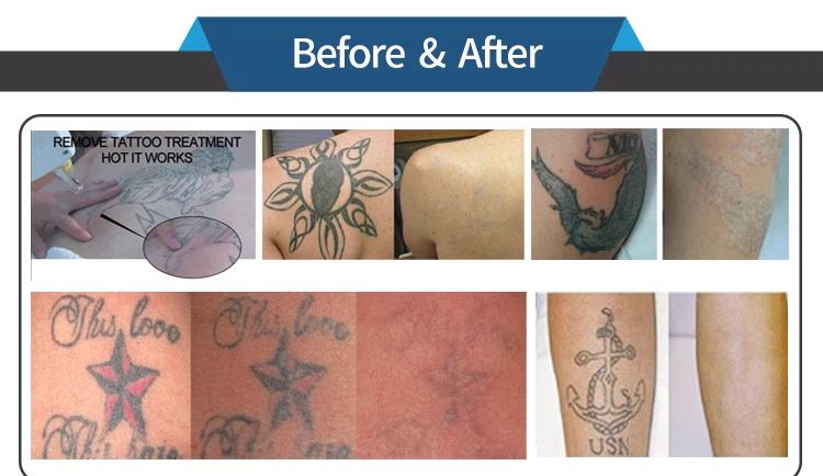 tattoo removal machine tattoo removal machine
