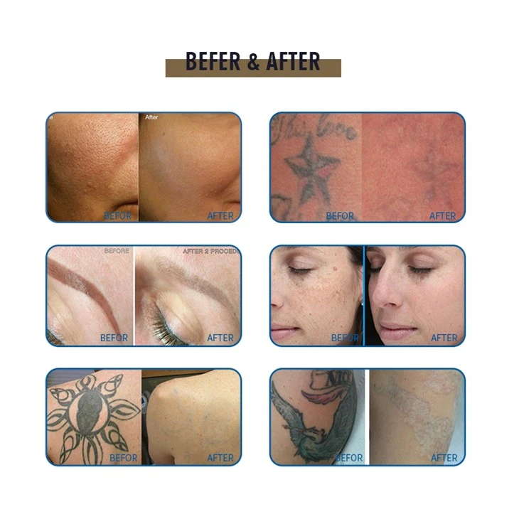 Q-Switch ND YAG Laser Tattoo Removal Machine